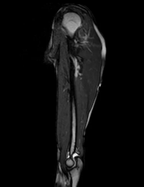 mra upper arm loc 3 - MRI