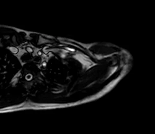 mra upper arm loc 4 - MRI