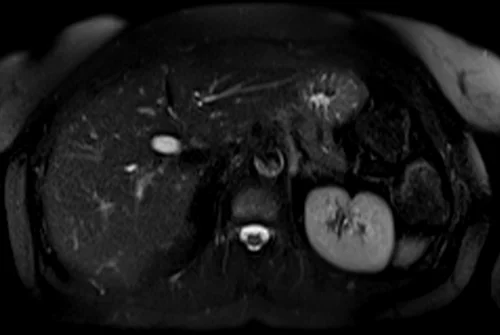 mrcp axial haste image 2 - MRI