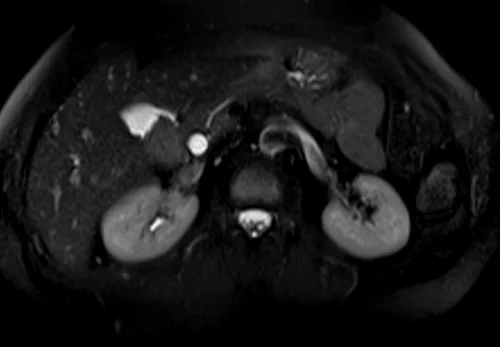 mrcp axial haste image 3 - MRI