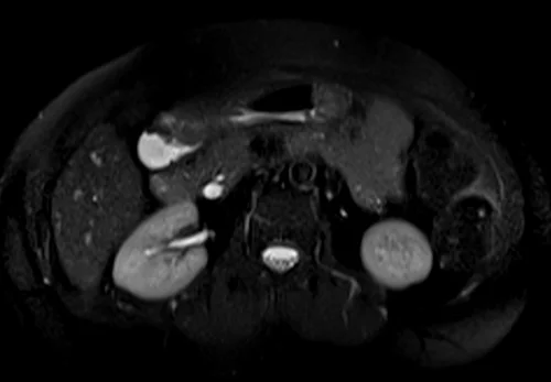 mrcp axial haste image 4 - MRI