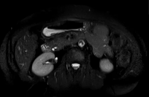 mrcp axial haste image 5 - MRI