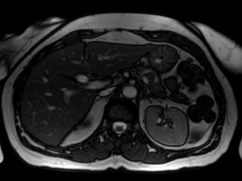 mrcp axial trufi image 2 - MRI