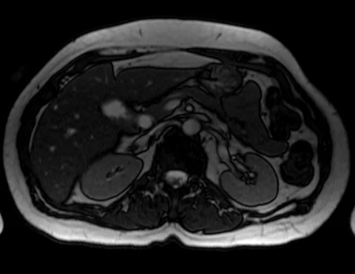 mrcp axial trufi image 3 - MRI
