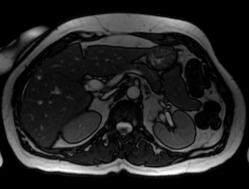 mrcp axial trufi image 4 - MRI