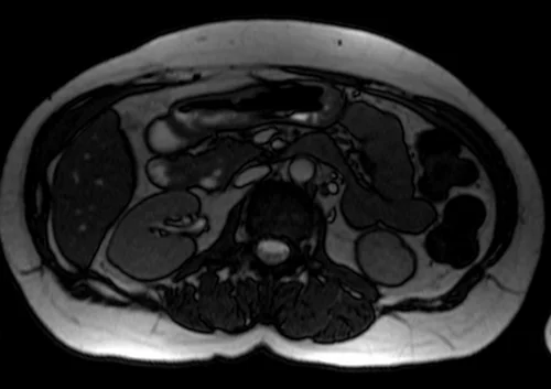 mrcp axial trufi image 5 - MRI
