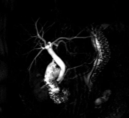 mrcp coronal haste thick slab image 1 - MRI