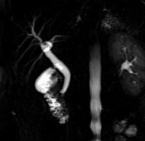 mrcp coronal haste thick slab image 2 - MRI