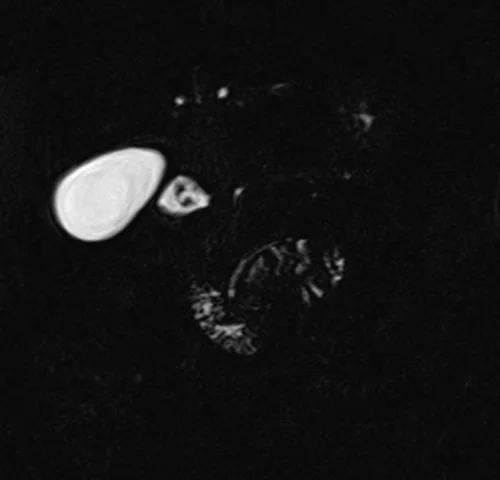 mrcp coronal space 3d(t2 tse fat sat 3d) image 1 - MRI