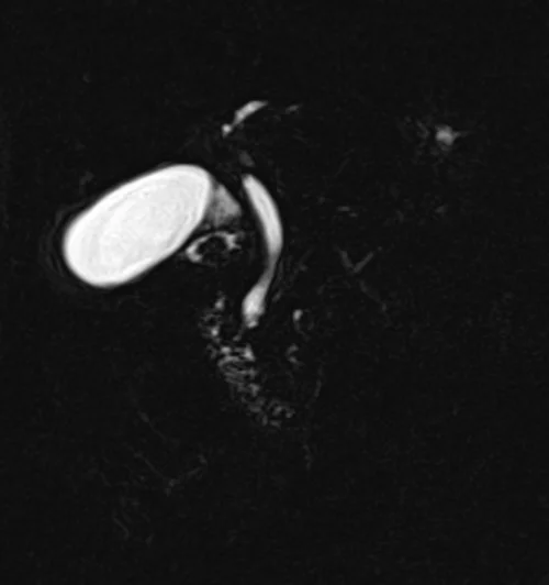 mrcp coronal space 3d(t2 tse fat sat 3d) image 2 - MRI