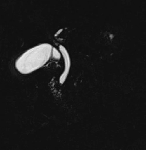 mrcp coronal space 3d(t2 tse fat sat 3d) image 3 - MRI