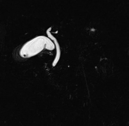 mrcp coronal space 3d(t2 tse fat sat 3d) image 4 - MRI