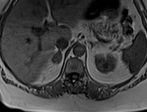 mri adrenal in phase image 2 - MRI