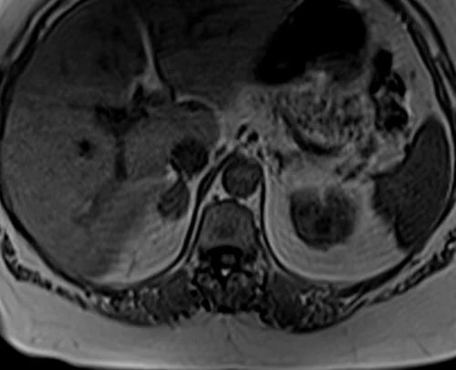 mri adrenal in phase image 3 - MRI