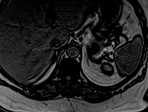 mri adrenal in phase image 4 - MRI