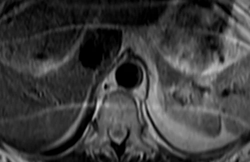 mri adrenal t2 tse breath hold axial 1 - MRI