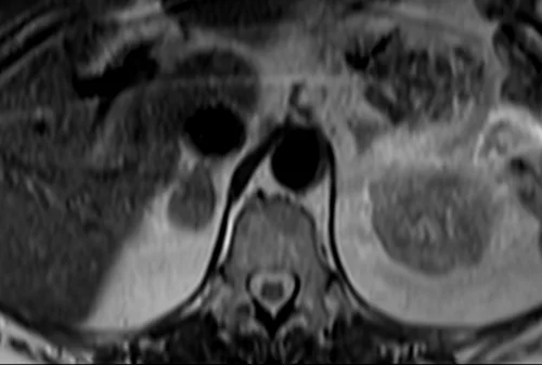 mri adrenal t2 tse breath hold axial 2 - MRI