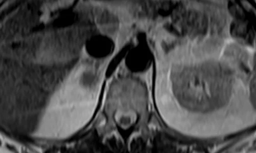 mri adrenal t2 tse breath hold axial 3 - MRI