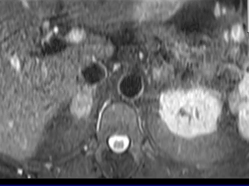 mri adrenal t2 tse fat sat breath hold axial 2 - MRI