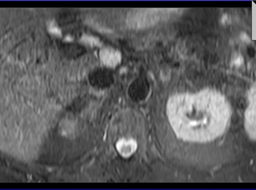 mri adrenal t2 tse fat sat breath hold axial 3 - MRI