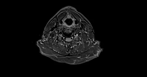 mri brachial plexus axial stir image 1 - MRI