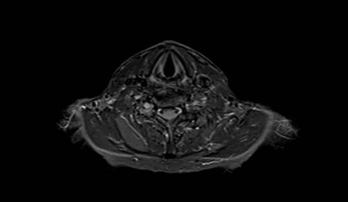 mri brachial plexus axial stir image 2 - MRI