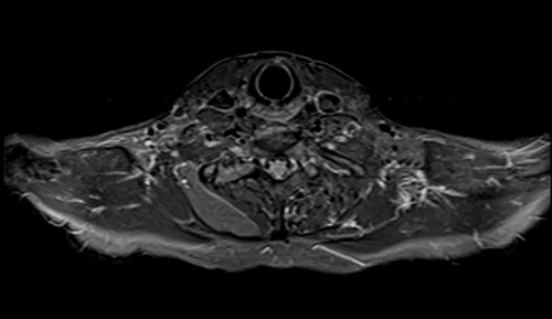 mri brachial plexus axial stir image 3 - MRI