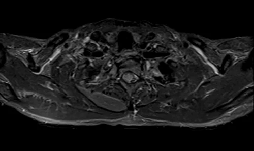 mri brachial plexus axial stir image 4 - MRI