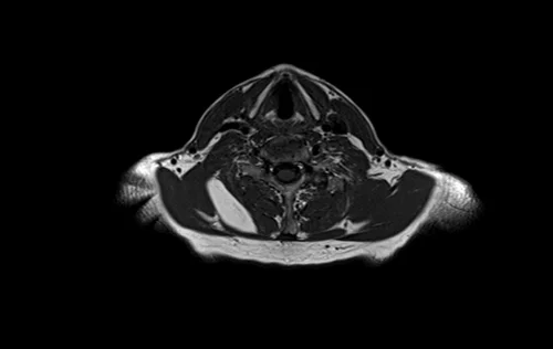 mri brachial plexus axial t1 image 2 - MRI
