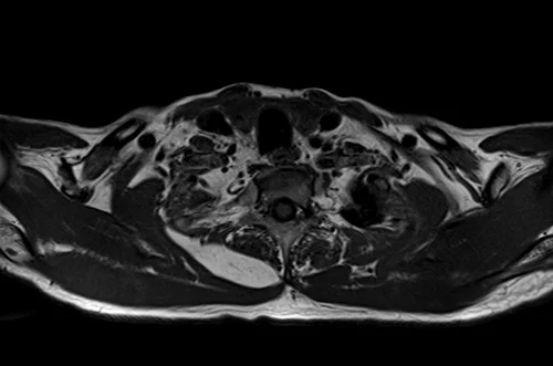 mri brachial plexus axial t1 image 4 - MRI