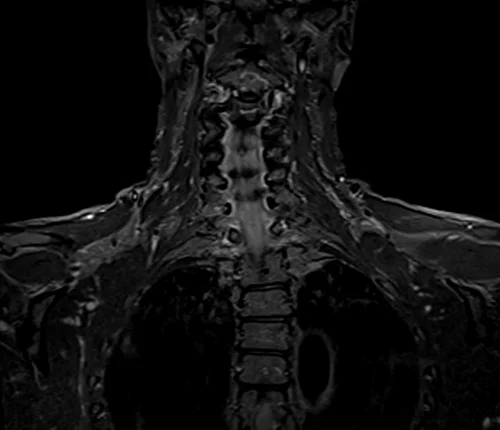 mri brachial plexus coronal stir image 1 - MRI