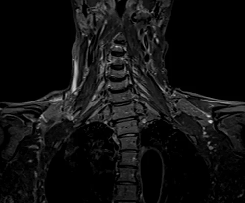 mri brachial plexus coronal stir image 2 - MRI