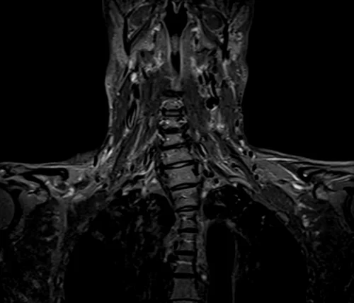 mri brachial plexus coronal stir image 3 - MRI