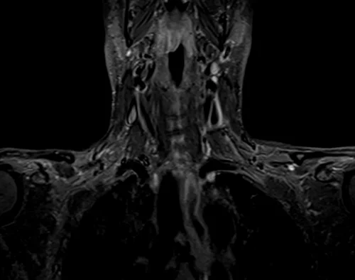 mri brachial plexus coronal stir image 4 - MRI