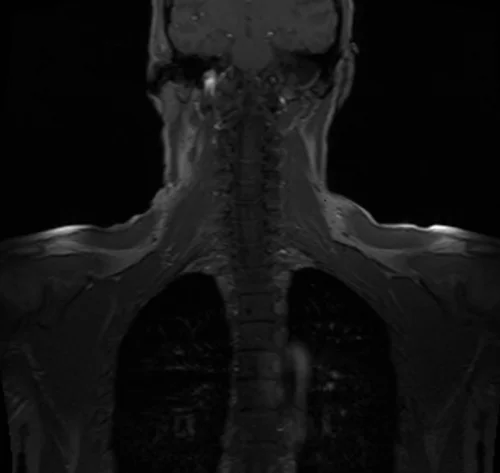 mri brachial plexus localizer 1 - MRI