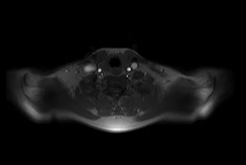 mri brachial plexus localizer 2 - MRI