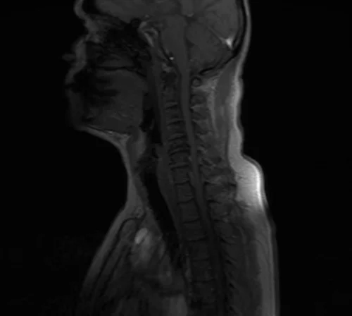 mri brachial plexus localizer 3 - MRI