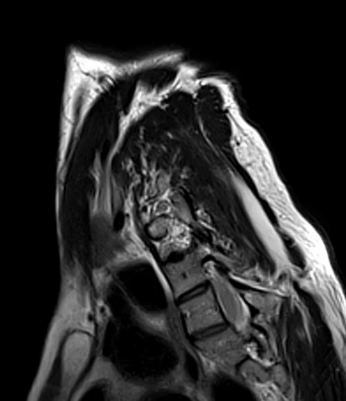 mri brachial plexus sagittal oblique t2 image 1 - MRI
