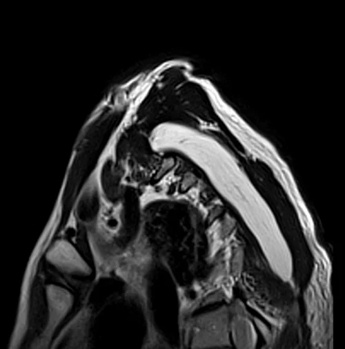 mri brachial plexus sagittal oblique t2 image 2 - MRI
