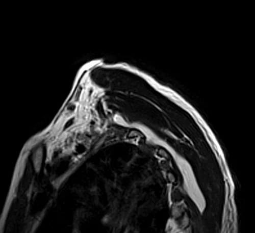 mri brachial plexus sagittal oblique t2 image 3 - MRI