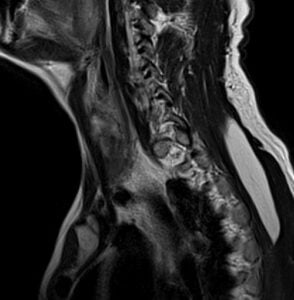 MRI brachial plexus sagittal T2 images