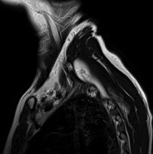 mri brachial plexus sagittal t2 image 2 - MRI