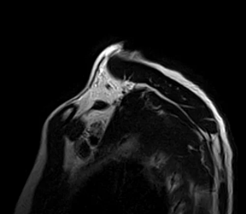 mri brachial plexus sagittal t2 image 3 - MRI