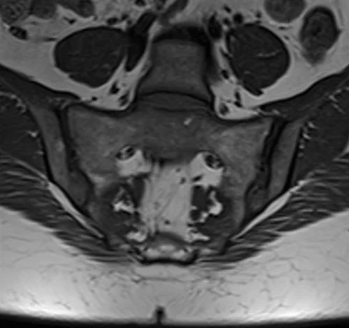 mri coronal t1 sij’s image 1 - MRI
