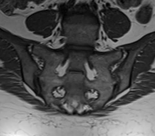 PLAN SIJ T1 coronal - mrimaster