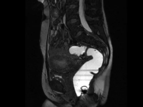 mri defecography (proctogram mri) localiser 1 - MRI