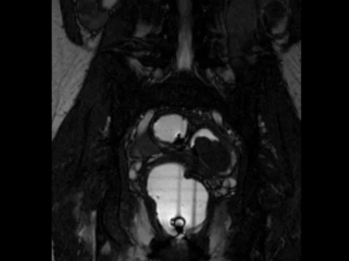 mri defecography (proctogram mri) localiser 2 - MRI
