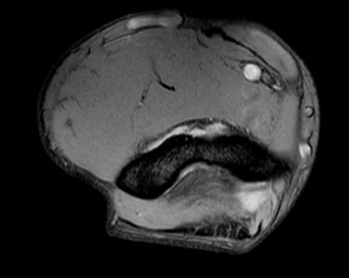 mri elbow axial medic image 1 - MRI