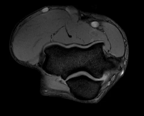 mri elbow axial medic image 2 - MRI