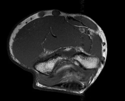 mri elbow axial t1 image 1 - MRI